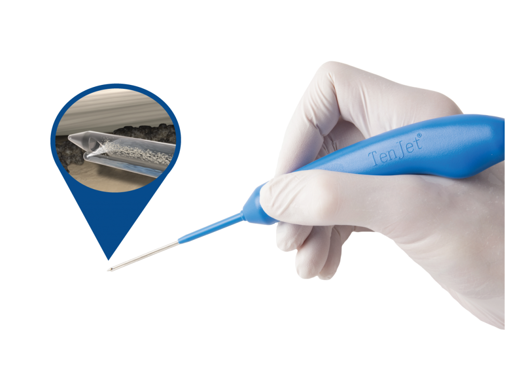 The TenJet device's 12-gauge needle tip, used to selectively resect diseased rotator cuff tendon tissue
